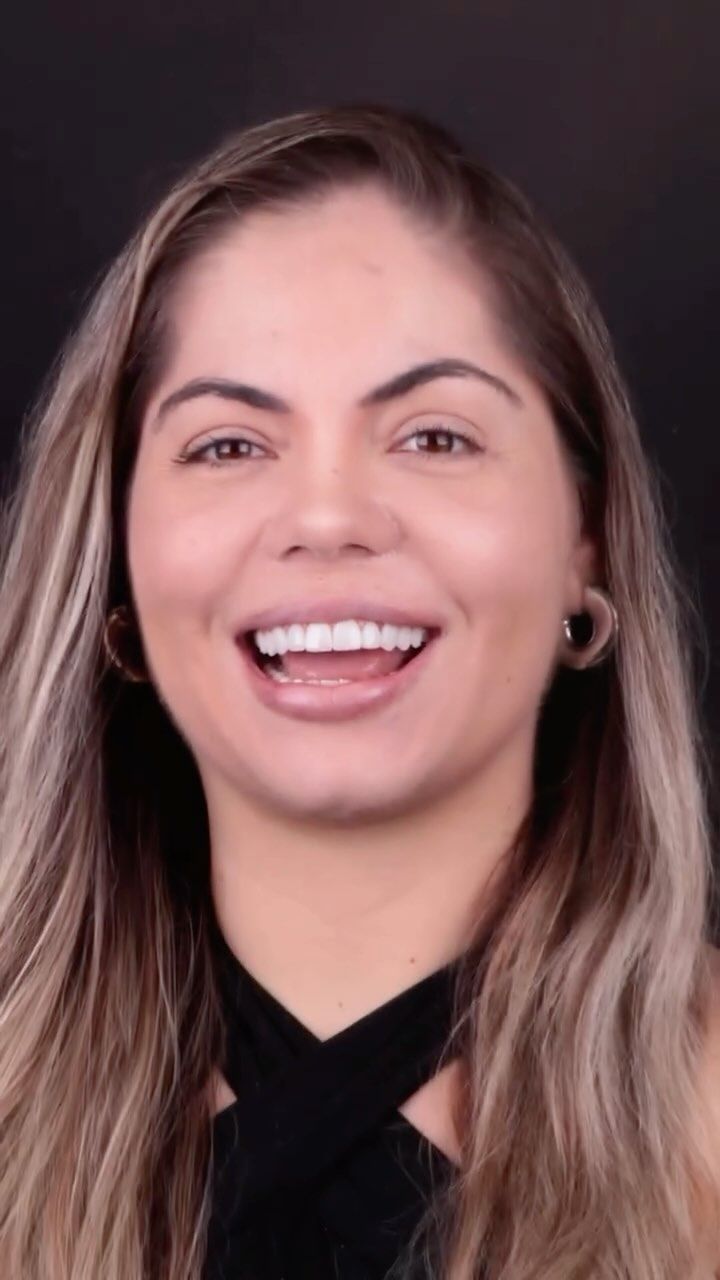 Paciente sorrindo com lentes em resina
