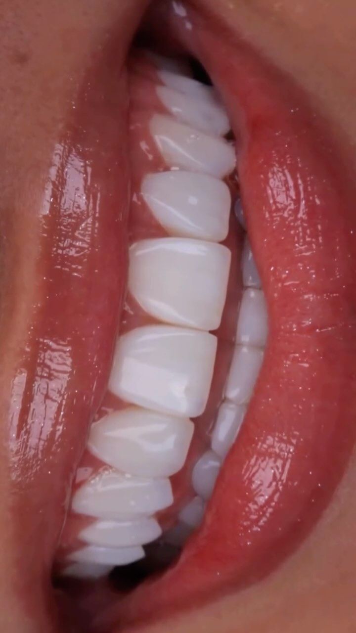 Detalhe de lentes em resina feitas pelo Dr. Daniel Ferreira